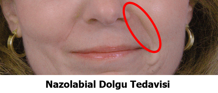 Nazolabial Dolgu Nereye Yapılır ?