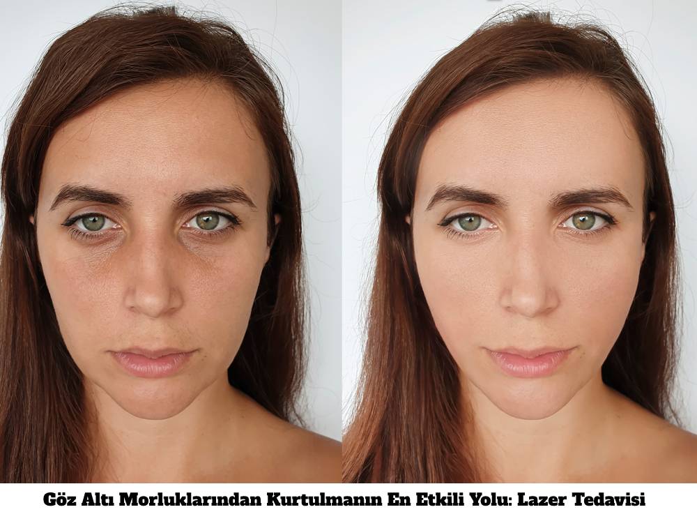 Göz Altı Morlukları Nedenleri Ve Tedavisi
