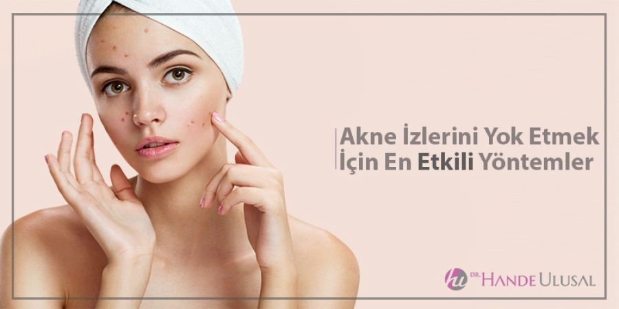 Akne İzlerini Yok Etmek İçin En Etkili Yöntemler