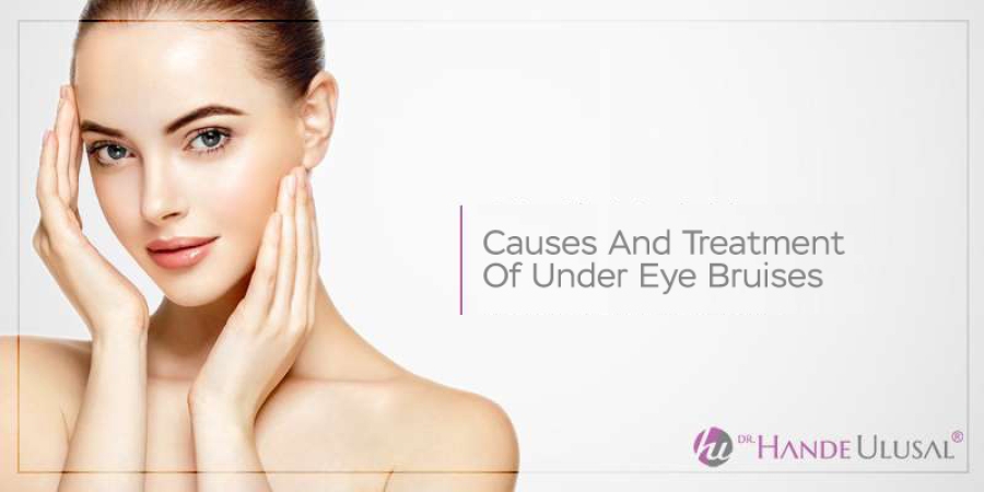 Causes and Treatment of Under Eye Bruises
