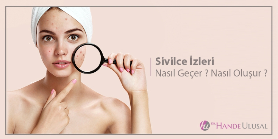 Sivilce İzleri Nasıl Geçer ? Sivilce İzleri Neden Oluşur ?